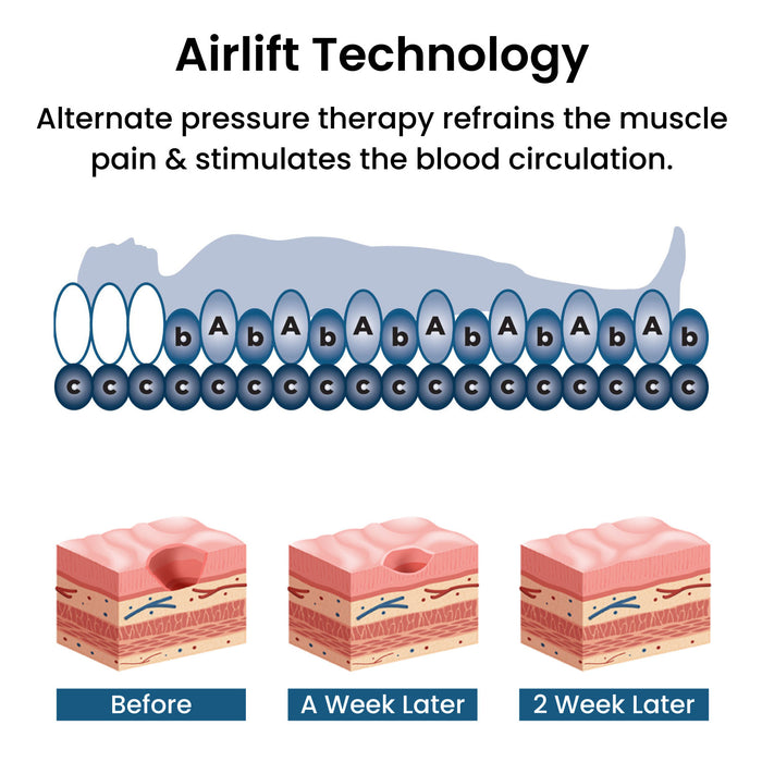 Anti Decubitus Medical Air Bubble Mattress – King Size, CE Approved, Vibration-Free with Energy-Efficient Pump for Bedridden Patients – EasyCare India (Blue)